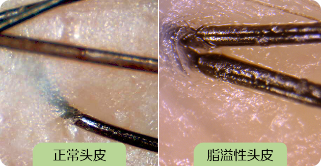 正常头皮与脂溢性头发图