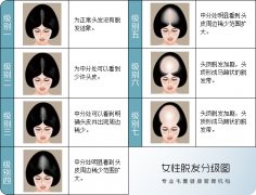 出现这几种情况你可要注意了 1分钟脱发自测