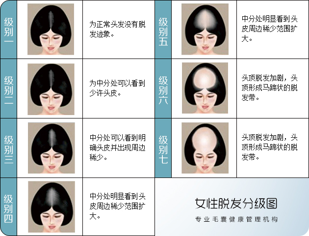 女性脱发等级对照图